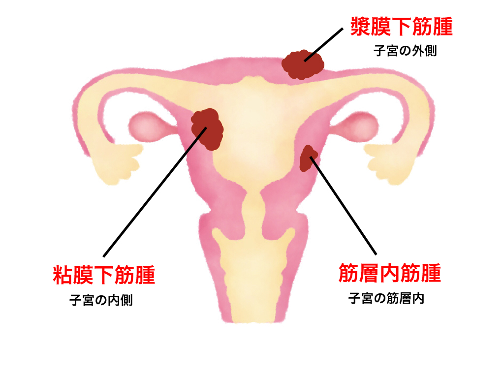 筋腫 子宮