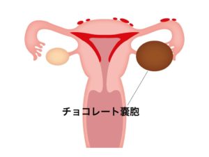 子宮内膜症の漢方での対処法 漢方薬カワシマ 大崎 仙台 栗原 宮城の漢方相談