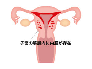 子宮内膜症の漢方での対処法 漢方薬カワシマ 大崎 仙台 栗原 宮城の漢方相談