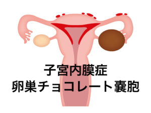 子宮内膜症の漢方での対処法